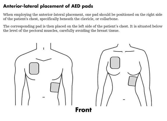 Drawings of male and female torsos showing AED pad placement